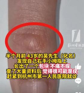 43岁男子手指异样，疑感染HPV引关注